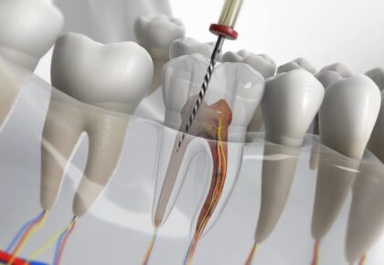Kanal tedavisi yapılan bir diş temsili olarak resmedilmiş.