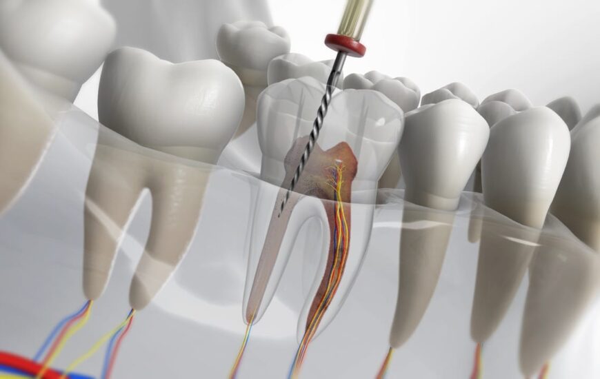 Kanal tedavisi yapılan bir diş temsili olarak resmedilmiş.