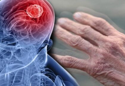 Bir insan silüeti beyin tarafına odaklanılmış, parkinson hastalığını tetikleyen bölge gösterilmekte. Sağ kısımda ise ellerin titrediğini belirten yaşlı bir el bulunmakta