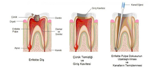 enfekte, çürük temizliği ve kanalın temizlenmesi ile ilgili diş grafiği
