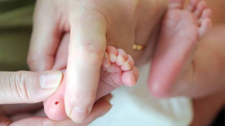 Bir bebekten Kalıtsal bir hastalık olan Fenilketonür için topuk kanı alınmaktadır. Hemşire bebeğin ayağını hafifçe kan gelmesi için iki eli ile sıkmaktadır.