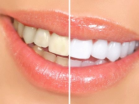 Öncesi ve sonrası fotoğrafı. Soldaki kısımda dişler sarı, sağdaki kısımda ise dişler beyaz.