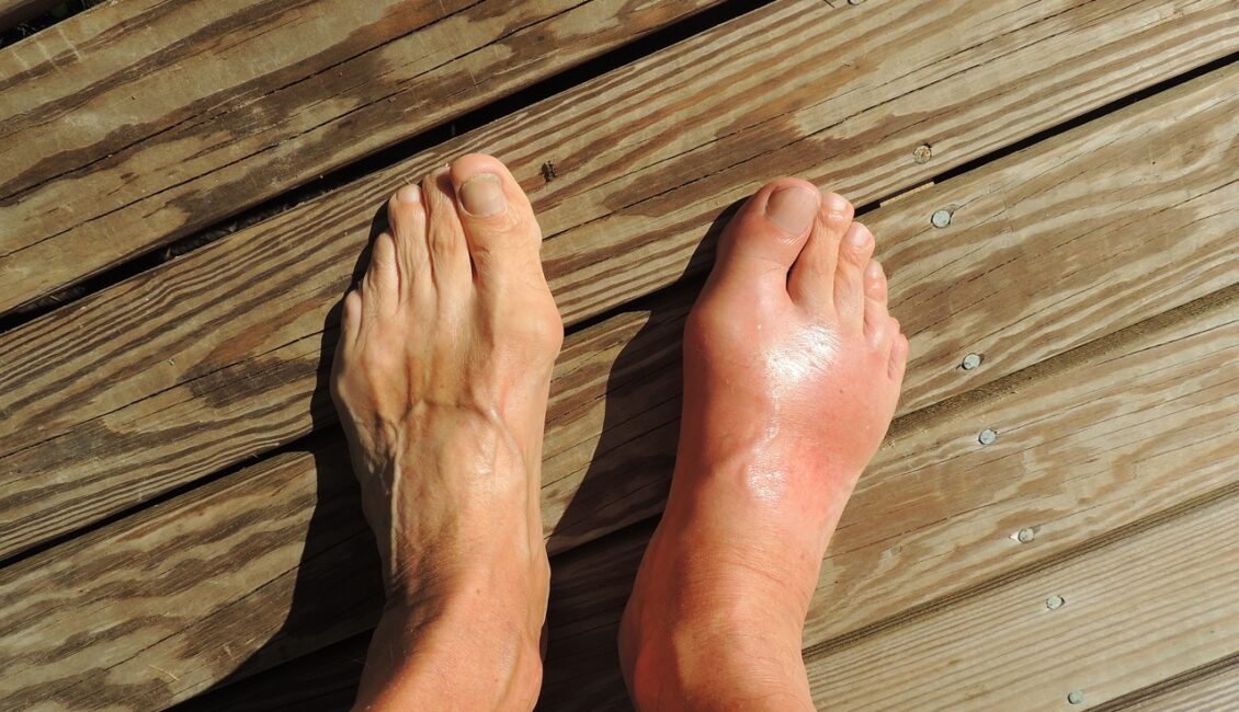 Ahşap zeminden oluşan bir yerde bir erkek ayağı gözükmekte. sağ ayakta gut hastalığı belirtileri gözükmekte, sol ayak ise normal gözükmekte.