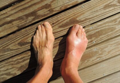Ahşap zeminden oluşan bir yerde bir erkek ayağı gözükmekte. sağ ayakta gut hastalığı belirtileri gözükmekte, sol ayak ise normal gözükmekte.