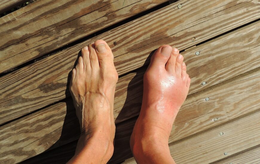 Ahşap zeminden oluşan bir yerde bir erkek ayağı gözükmekte. sağ ayakta gut hastalığı belirtileri gözükmekte, sol ayak ise normal gözükmekte.