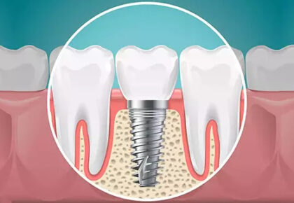 Oral implantolojiye dair bir çizim görsel.