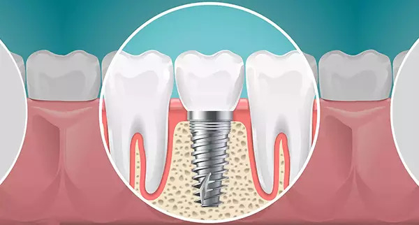 Oral implantolojiye dair bir çizim görsel.
